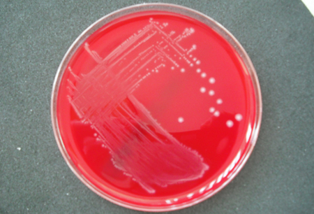 B 型链球菌感染 images