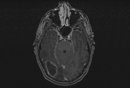 Brain abscess images