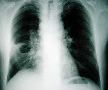 Lung abscess images