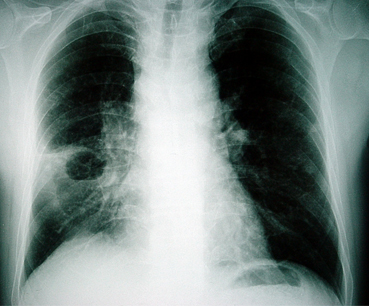 Absceso pulmonar images