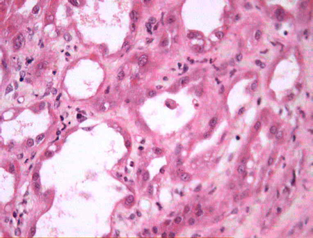 Acute tubular necrosis images