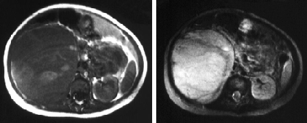 Wilms tumor images