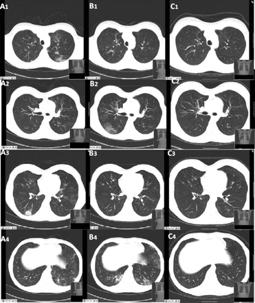 Granulomatose eosinofílica com poliangiite (Síndrome de Churg-Strauss) images