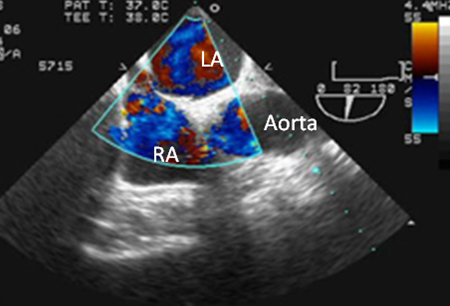 Patent foramen ovale images