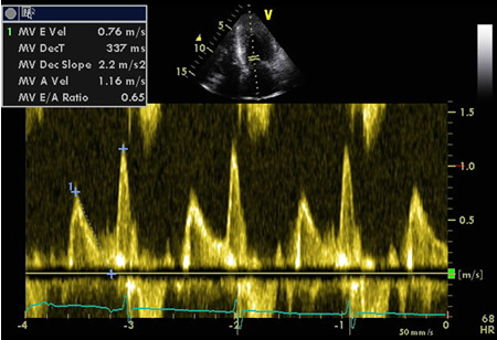 Heart failure with preserved ejection fraction images