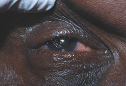 Trachoma images