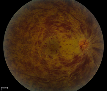 Retinal vein occlusion images