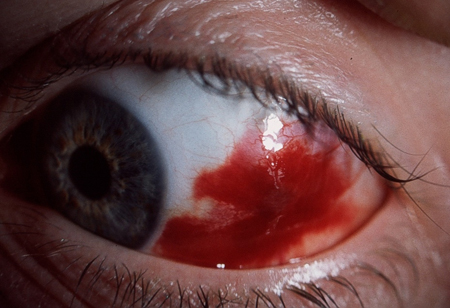 Eye trauma images