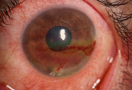 Dry eye disease images