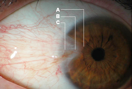 Pterygium images