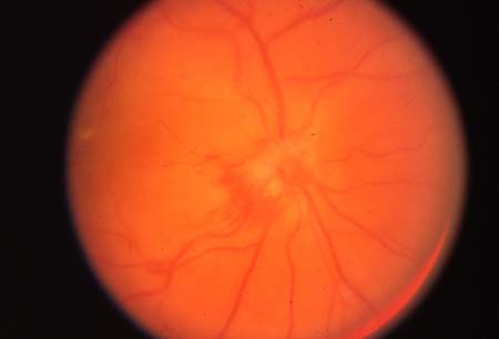 Optic neuritis images