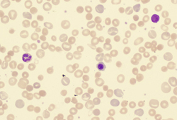 Hemolytic anemia images