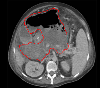 Intra-abdominal abscess images