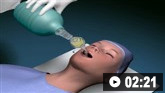 Demostración animada de la intubación traqueal