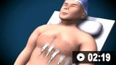 Demostración animada de como realizar un electrocardiograma (ECG)