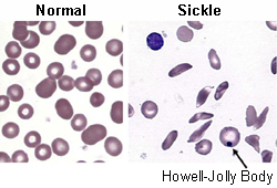 Sickle cell anemia - Investigations | BMJ Best Practice