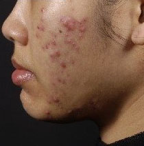acne nodulocystica acne nodulocystica