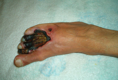 giant microbes gangrene