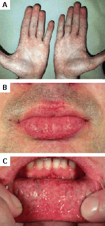 157 of what factors storage  Approach Common  lysosomal hereditary diseases