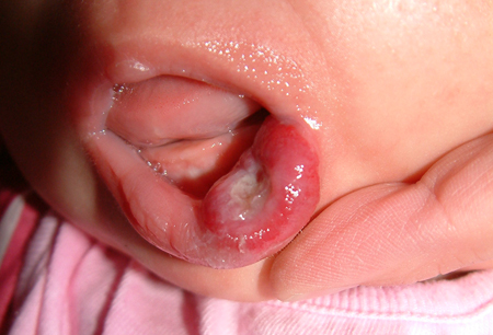 hemangioma symptoms diagnosis and