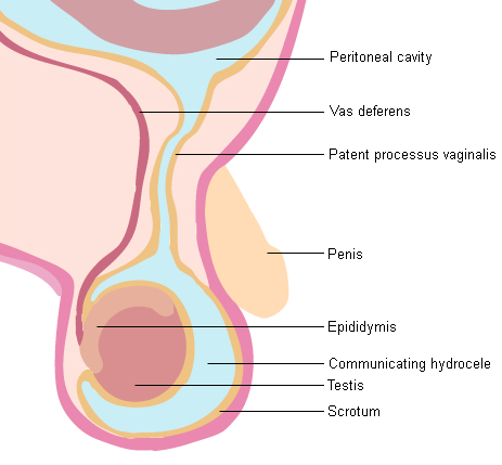 hydrocele symptoms diagnosis and treatment bmj best practice