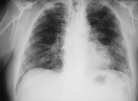 Pneumoconioses - Images | BMJ Best Practice