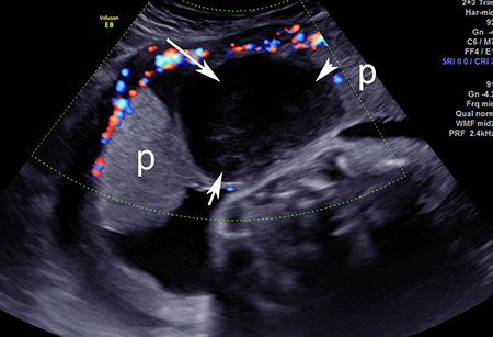 Placental abruption - Investigations | BMJ Best Practice