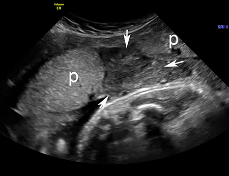 Placental abruption - Investigations | BMJ Best Practice