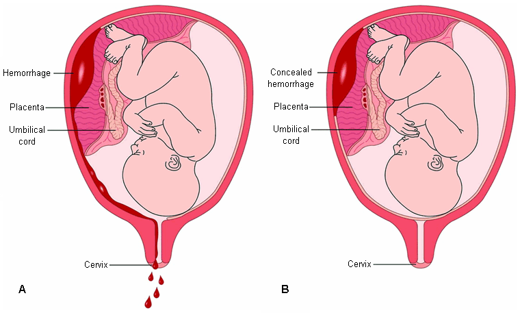Placental abruption - Symptoms, diagnosis and treatment | BMJ Best ... Placental abruption - Symptoms, diagnosis and treatment | BMJ Best ...