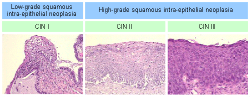 lsil-what-causes-high-grade-squamous-intraepithelial-lesion-so