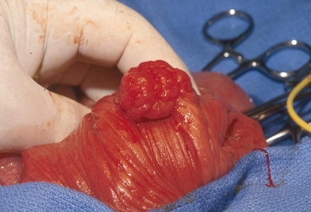 peutz-jeghers syndrome