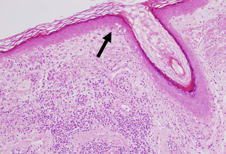 Discoid lupus erythematosus - Symptoms, diagnosis and treatment | BMJ ...