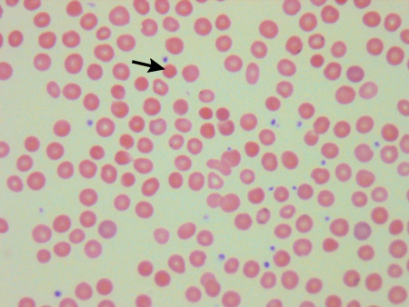 esferocitose hereditria