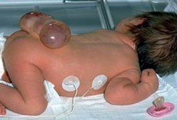 neural tube defects