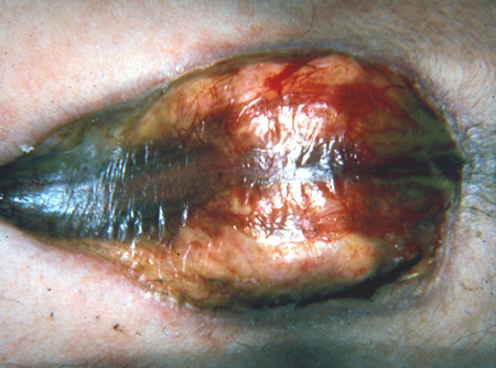 neural tube defects