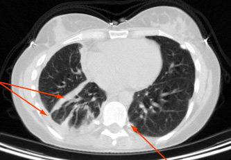 Mesothelioma - Approach | BMJ Best Practice