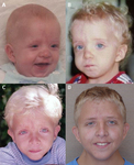 Noonan syndrome - Images | BMJ Best Practice