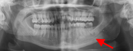 Dental abscess - Investigations | BMJ Best Practice