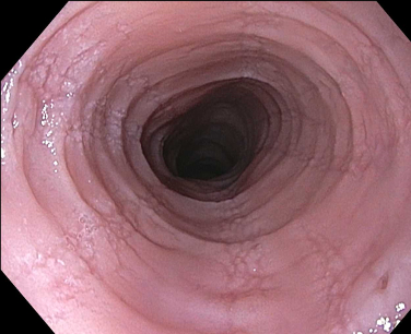 Eosinophilic esophagitis - Symptoms, diagnosis and ...