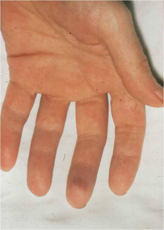 infective endocarditis history and exam bmj best practice