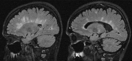 28+ Multiple Sclerosis Normal Vs Abnormal Brain Mri Images Pictures