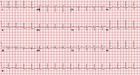 Stable ischemic heart disease - Symptoms, diagnosis and treatment | BMJ