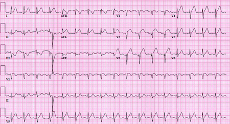 ST-elevation myocardial infarction - Images | BMJ Best Practice