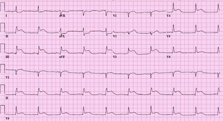 st elevation myocardial infarction images bmj best practice st elevation myocardial infarction