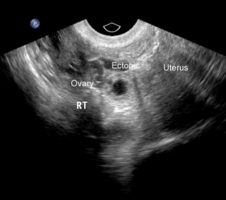 Ectopic pregnancy - Images | BMJ Best Practice