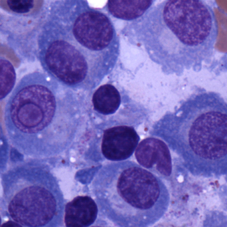 Multiple myeloma - Investigations | BMJ Best Practice