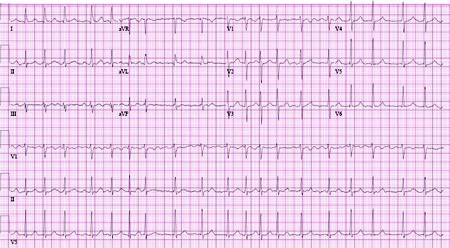 atrial flutter symptoms sweating
