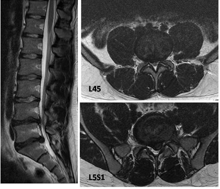 Discogenic low back pain - Images | BMJ Best Practice