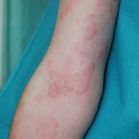 Differential Diagnosis Of Chronic Urticaria Download - vrogue.co