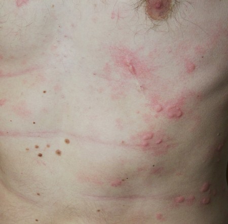 van e urticaria a férgektől
